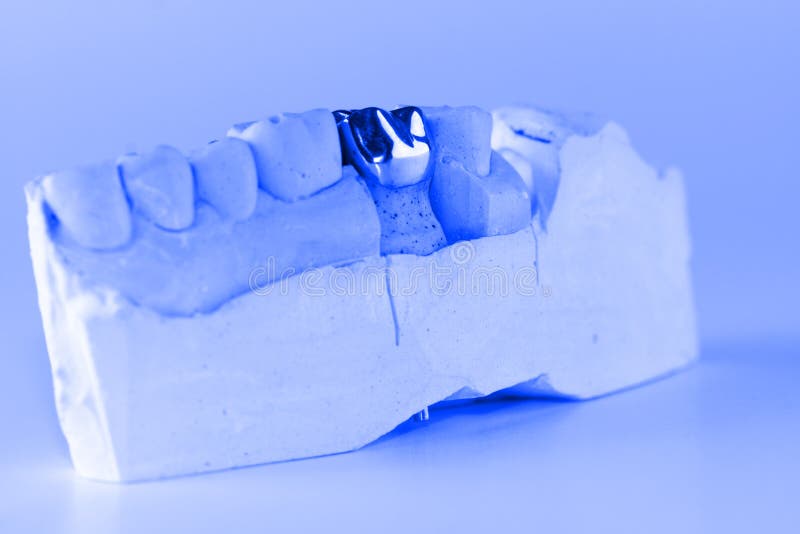 Cast metal dental crown stock photo. Image of office 86323346