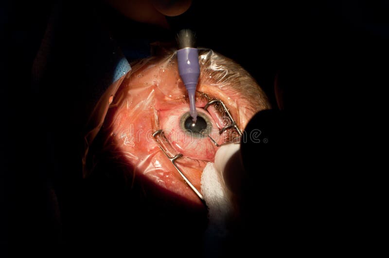 Preparation of the sick eye for cataract surgery. Preparation of the sick eye for cataract surgery