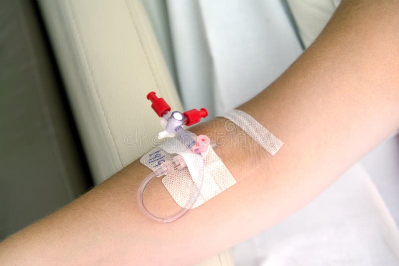 Catheter in the arm stock image. Image of hope, needle 76085935