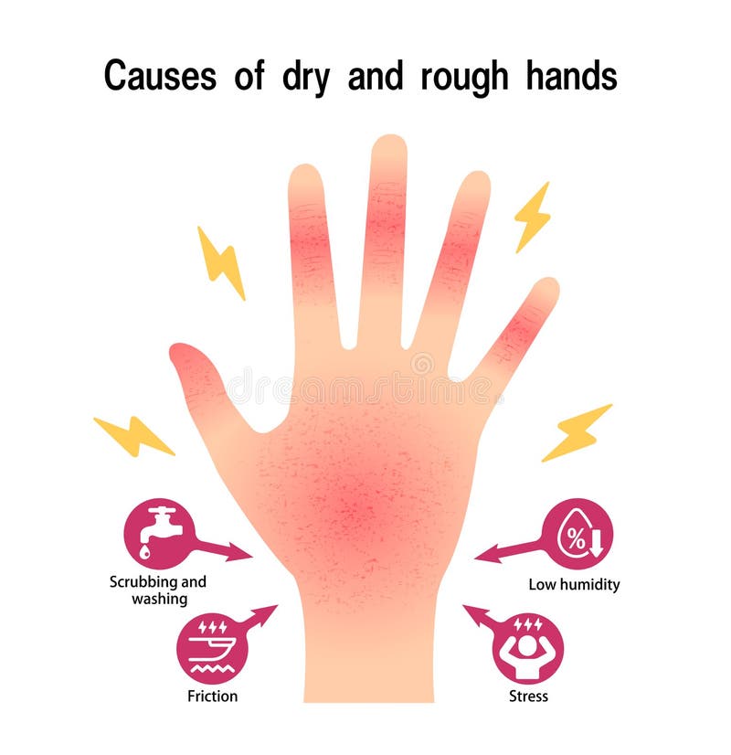 Causes of Dry and Rough Hands Chapped Hands Vector Illustration Stock Vector Illustration of