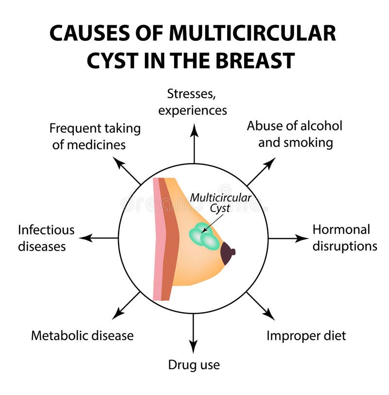 The Causes Of Multicameral Cyst World Breast Cancer Day Tumor Stock