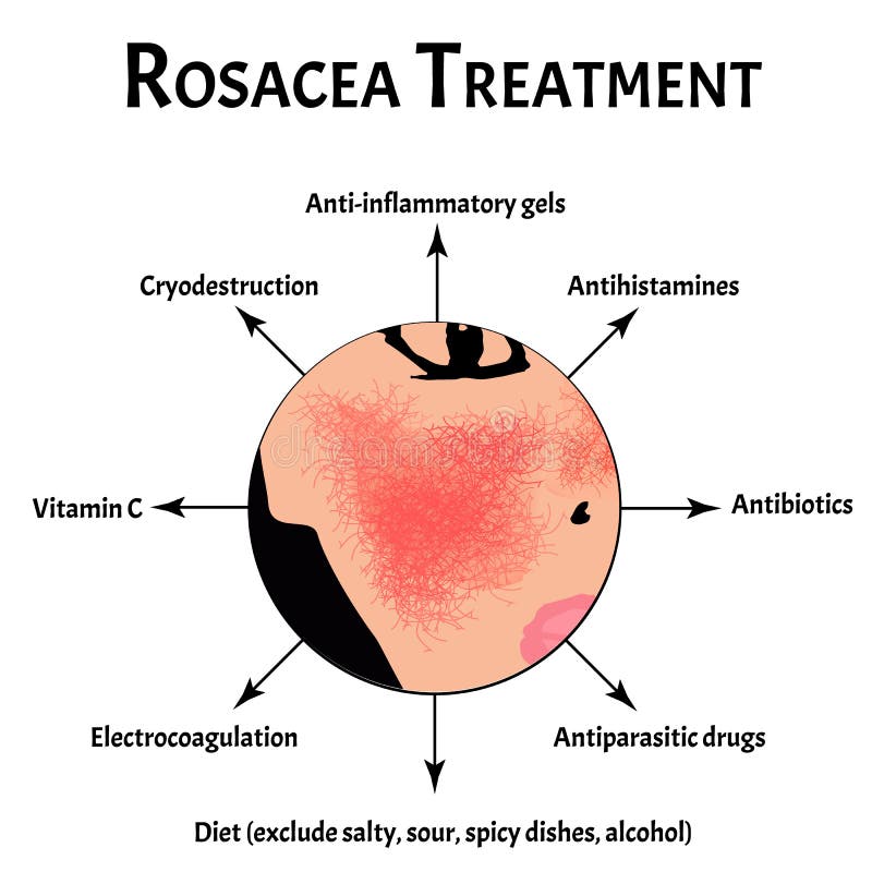 Causes of Rosacea. Rosacea Awareness Month. Infographics. Vector