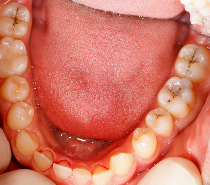 Cavidad y dientes imágenes de archivo libres de regalías Cavidad y dientes imágenes de archivo libres de regalías