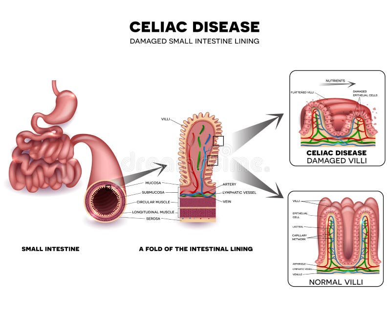 Celiac disease detailed anatomy, healthy intestinal villi and damaged unhealthy villi. Intestinal villi do not absorb nutrients because of reduced surface area. Celiac disease detailed anatomy, healthy intestinal villi and damaged unhealthy villi. Intestinal villi do not absorb nutrients because of reduced surface area.