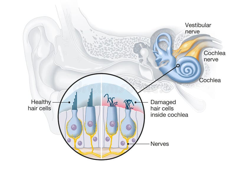 Cellules saines et endommagées d'acouphenes de cheveux à l'intérieur d'illustration médicale de la cochlée