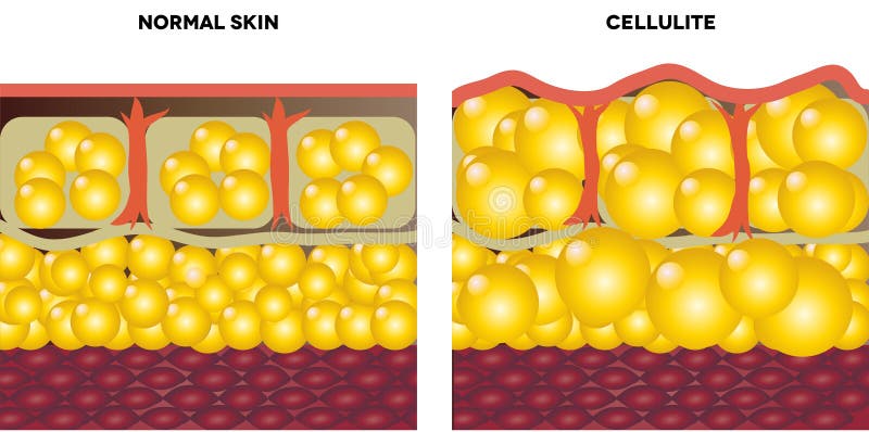 Celulitis piel.