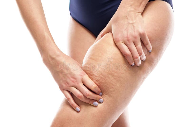 Cellulites sur les jambes femelles images libres de droits Cellulites sur les jambes femelles images libres de droits