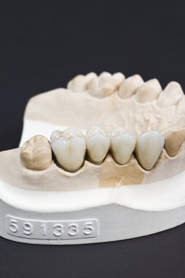Ceramic dental bridge stock image. Image of prosthetic 29102331