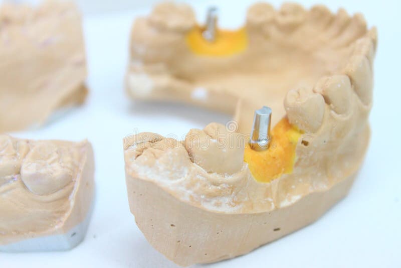 Ceramic Dental Crowns with Implants in a Lab Stock Photo Image of