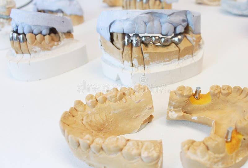 Ceramic Dental Crowns with Implants in a Lab Stock Photo Image of