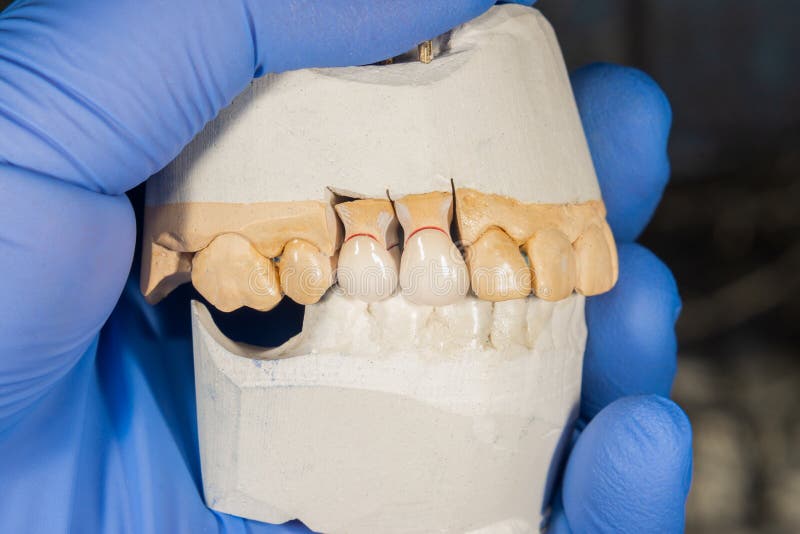 Ceramic Tooth Crown Closeup on a Plaster Model. Dental Prosthesis Stock Image Image of clinic