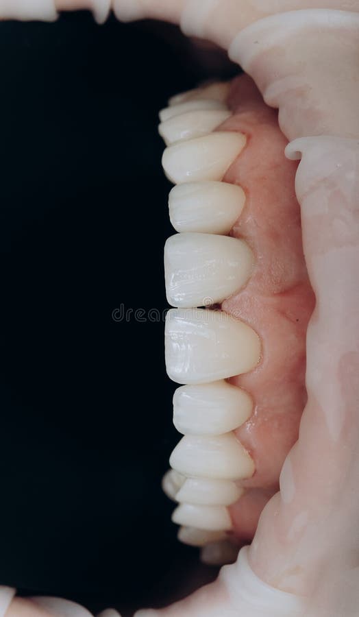Ceramic Zirconium in Final Version. Staining and Glazing Stock Photo Image of medical