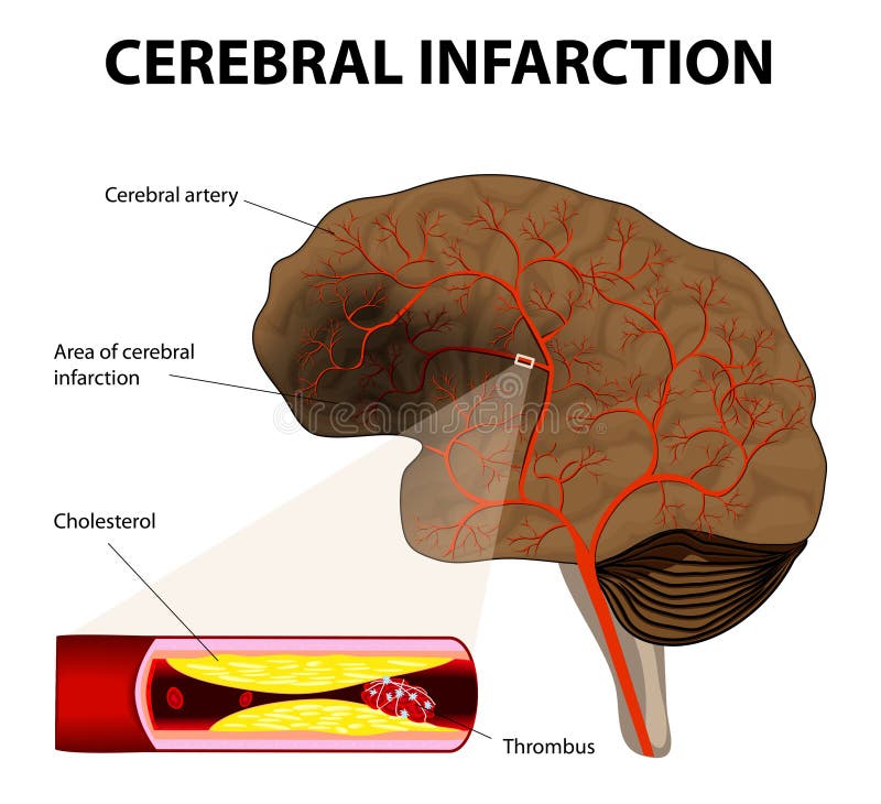Cerebral infarkt eller ischemic slaglängd stock illustrationer Cerebral infarkt eller ischemic slaglängd stock illustrationer