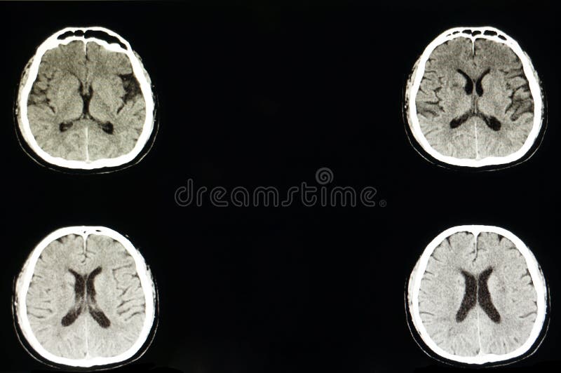 cerebral infarkt och atropy royaltyfria bilder cerebral infarkt och atropy royaltyfria bilder