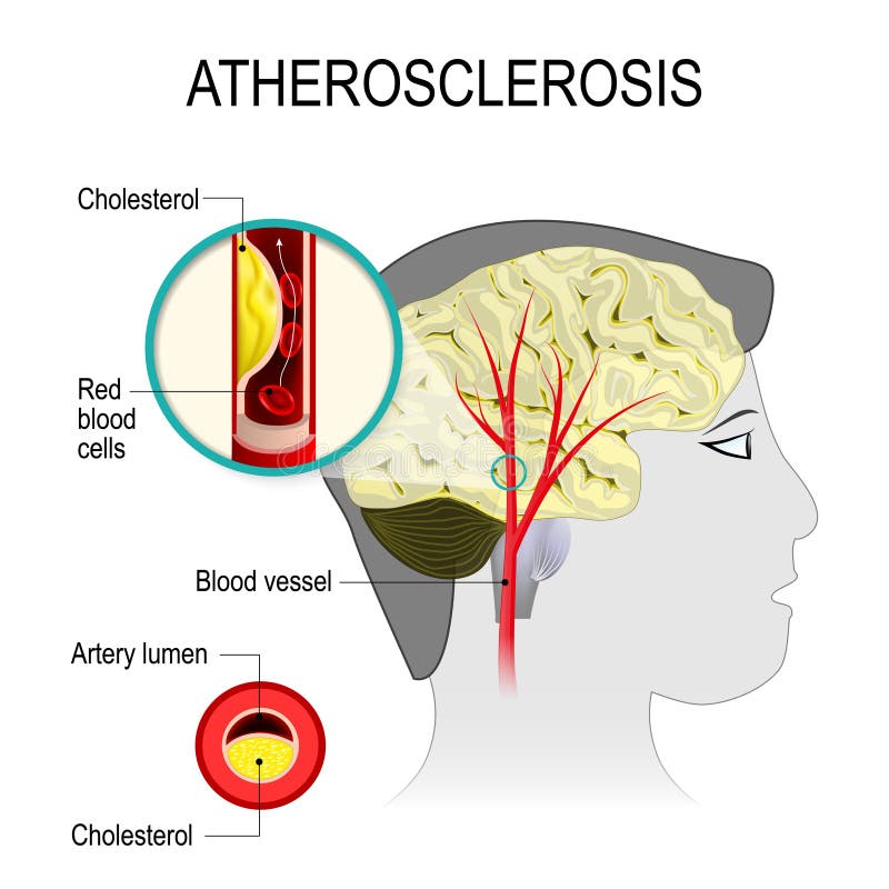 Cerebralna arteria z atherosclerosis royalty ilustracja Cerebralna arteria z atherosclerosis royalty ilustracja