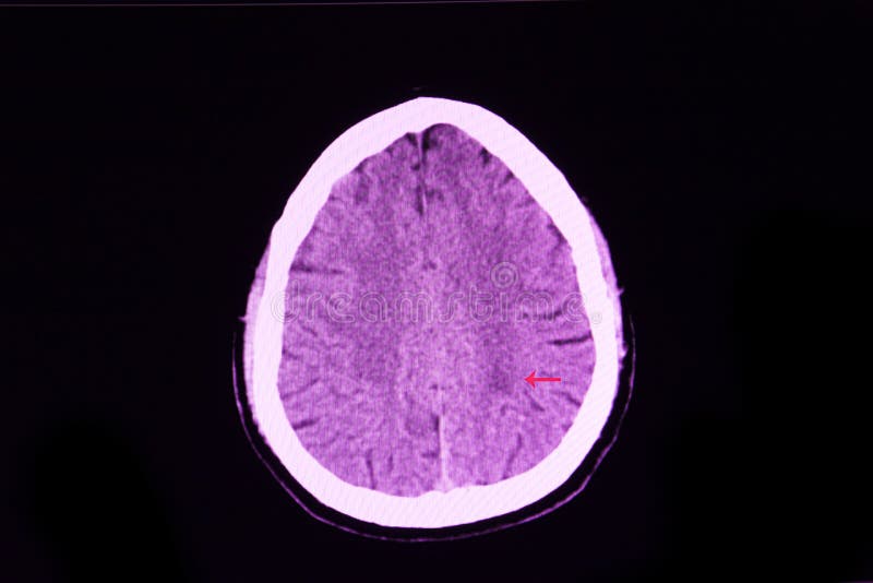 CT scan of a brian of a cerebral infarction patient with weakness in his right leg showing hypodense region in the posterior limb of left internal capsule, computer, tomography, xray, film, brain, stroke, diabetis, hypertension, hypertensive, cerebrum, ischemia, serious, diagnosis, background, neurosurgeon, doctor, emergency, urgency, treatment, surgery, human, image, medicine, medical, white, black, hospital, anatomy, bone, radiology, radiologist, disease, neurology, head, skull, cranium. CT scan of a brian of a cerebral infarction patient with weakness in his right leg showing hypodense region in the posterior limb of left internal capsule, computer, tomography, xray, film, brain, stroke, diabetis, hypertension, hypertensive, cerebrum, ischemia, serious, diagnosis, background, neurosurgeon, doctor, emergency, urgency, treatment, surgery, human, image, medicine, medical, white, black, hospital, anatomy, bone, radiology, radiologist, disease, neurology, head, skull, cranium