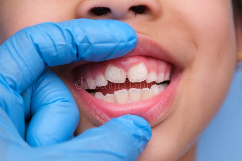 Niño Sonríe Con La Boca Cerrada Cerrando El Cierre De Un Concepto De Boca  De Niño Cuidado De La Piel De Niño Desarrollo Emocional Foto de archivo -  Imagen de oral, felicidad