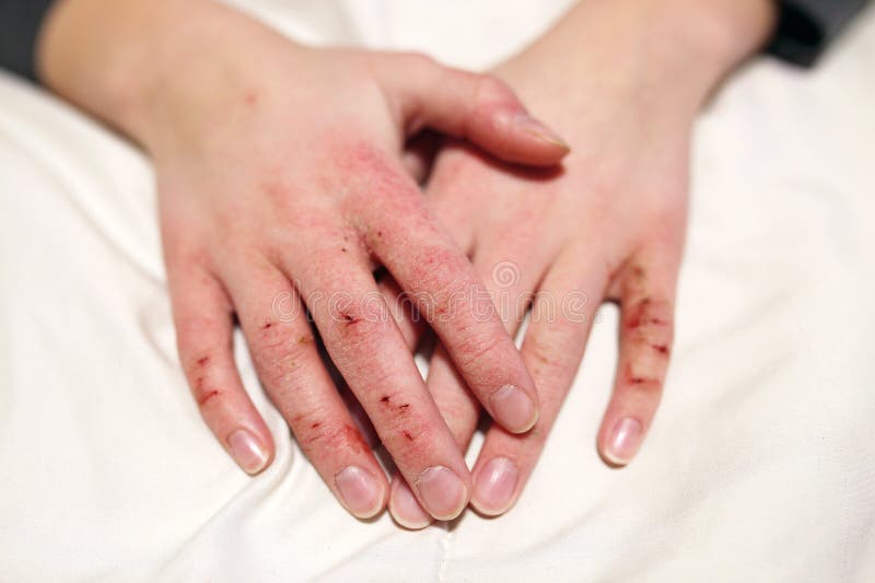 A close up on the hands of a young boy child with severely cracked and dry skin. A close up on the hands of a young boy child with severely cracked and dry skin