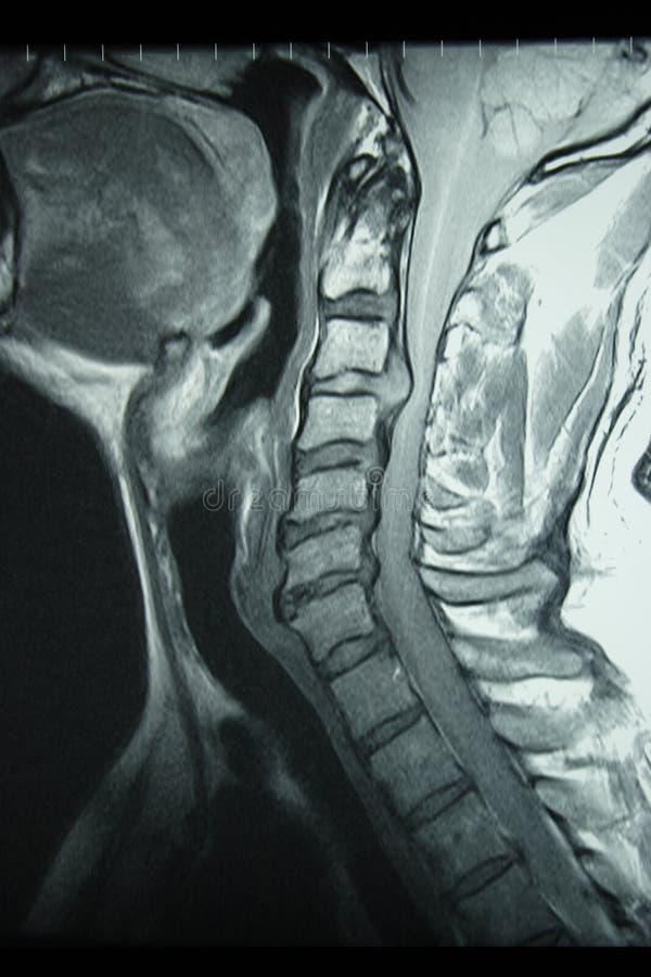Sagittal proton density MRI of the cervical spine, showing large disc herniation. Sagittal proton density MRI of the cervical spine, showing large disc herniation