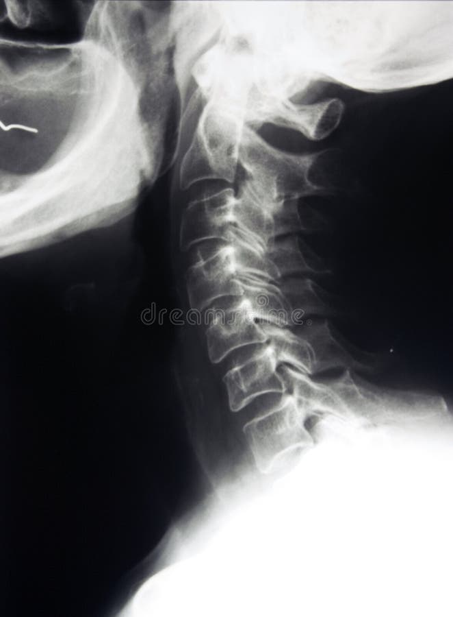 Xray of cervical spine, classical radiology RTG of neck. Xray of cervical spine, classical radiology RTG of neck
