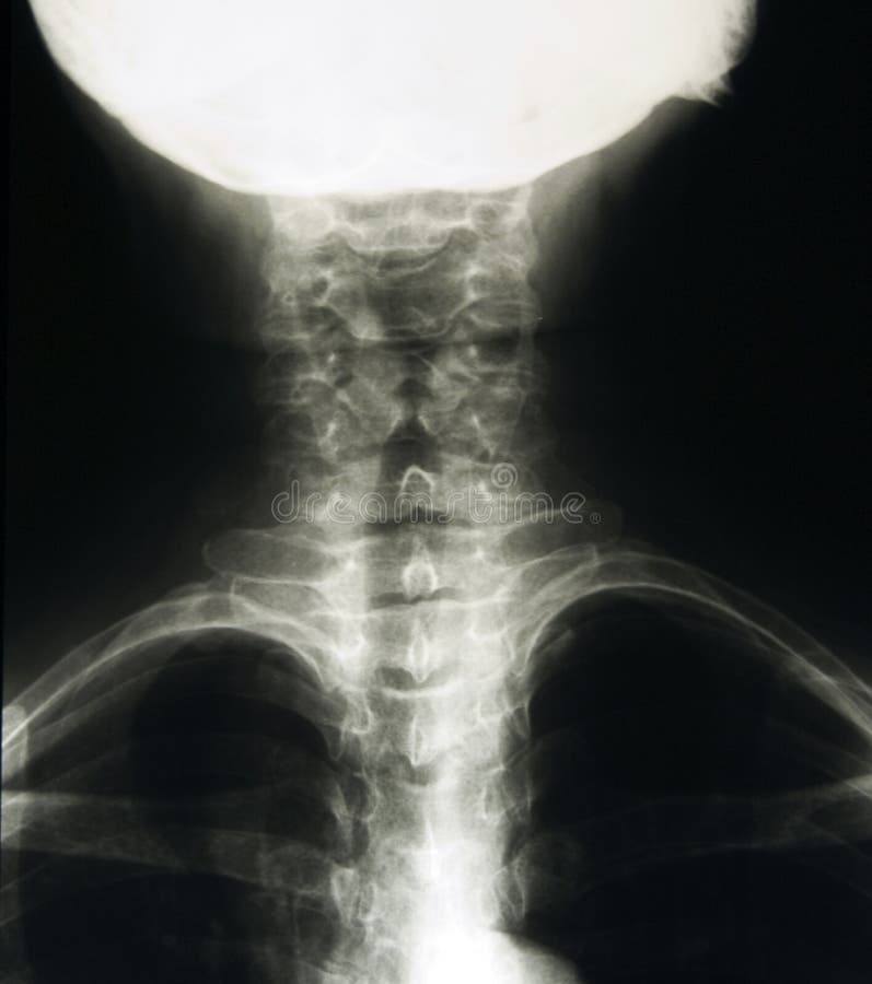 Xray of cervical spine, classical radiology RTG of neck. Xray of cervical spine, classical radiology RTG of neck