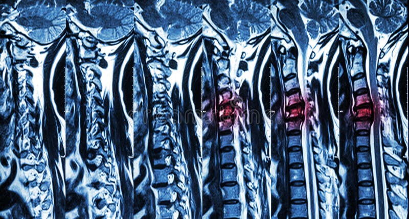 Cervical spondylosis with disc herniation ( MRI of cervical spine : show cervical spondylosis with disc herniation compress spinal cord ( Myelopathy ) )