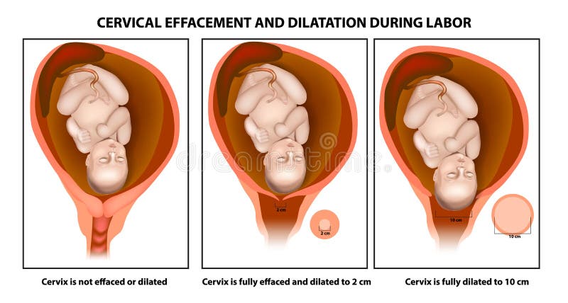 Cervicale uitwissing en dilatatie vector illustratie Cervicale uitwissing en dilatatie vector illustratie