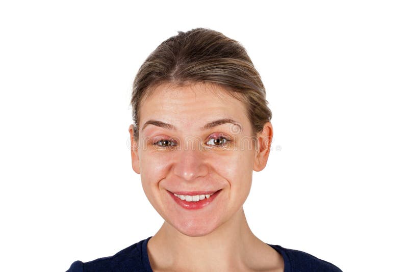  Chalazion - Augenlidinfektion stockbilder