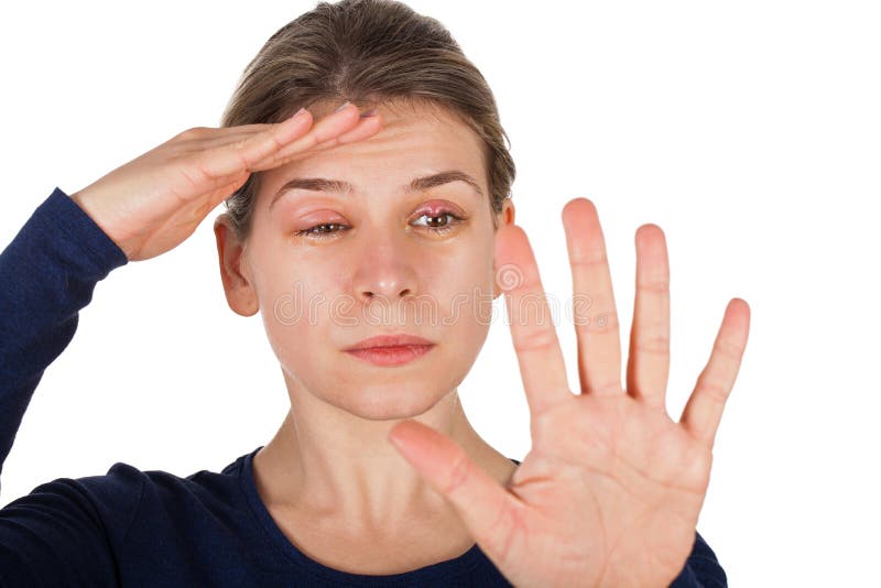  Chalazion - Augenlidinfektion lizenzfreie stockfotografie