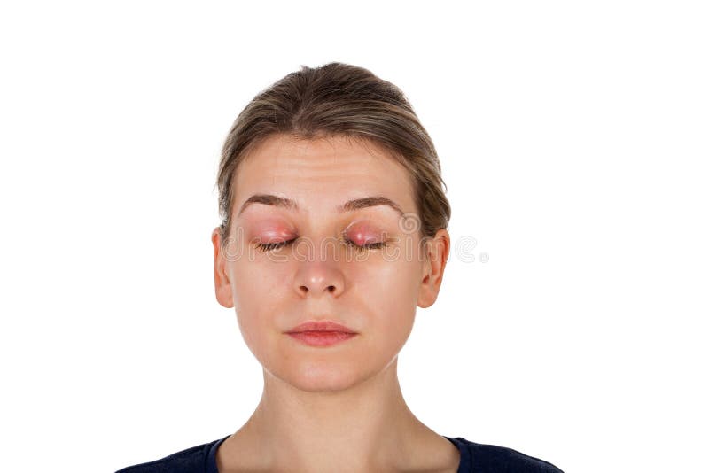  Chalazion - Augenlidinfektion stockfotografie