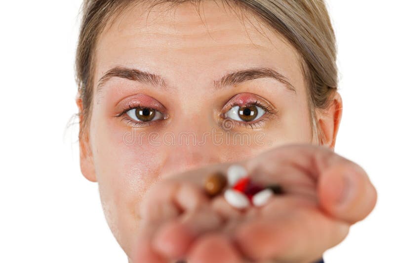  Chalazion - Augenlidinfektion lizenzfreies stockbild