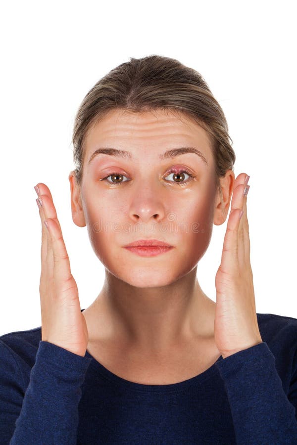  Chalazion - Augenlidinfektion stockfoto