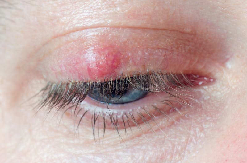 Chalazion On The Eyelid Of A Man Close Up Stock Image Image Of Face