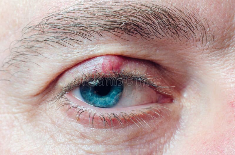 Chalazion On The Eyelid Of A Man Close Up Stock Photo Image Of