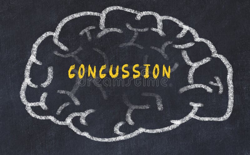 Chalk drawing of human brain with inscription concussion royalty free stock image