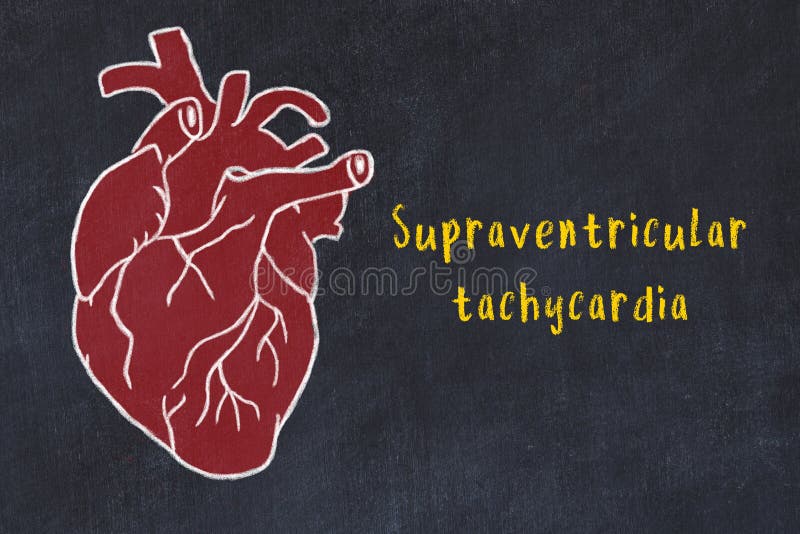 Supraventricular Tachycardia Stock Illustrations – 22 Supraventricular  Tachycardia Stock Illustrations, Vectors & Clipart - Dreamstime