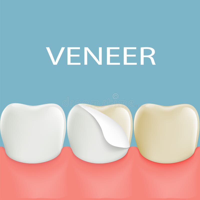 Chapas dentales en un diente humano existencias ilustración del vector Chapas dentales en un diente humano existencias ilustración del vector