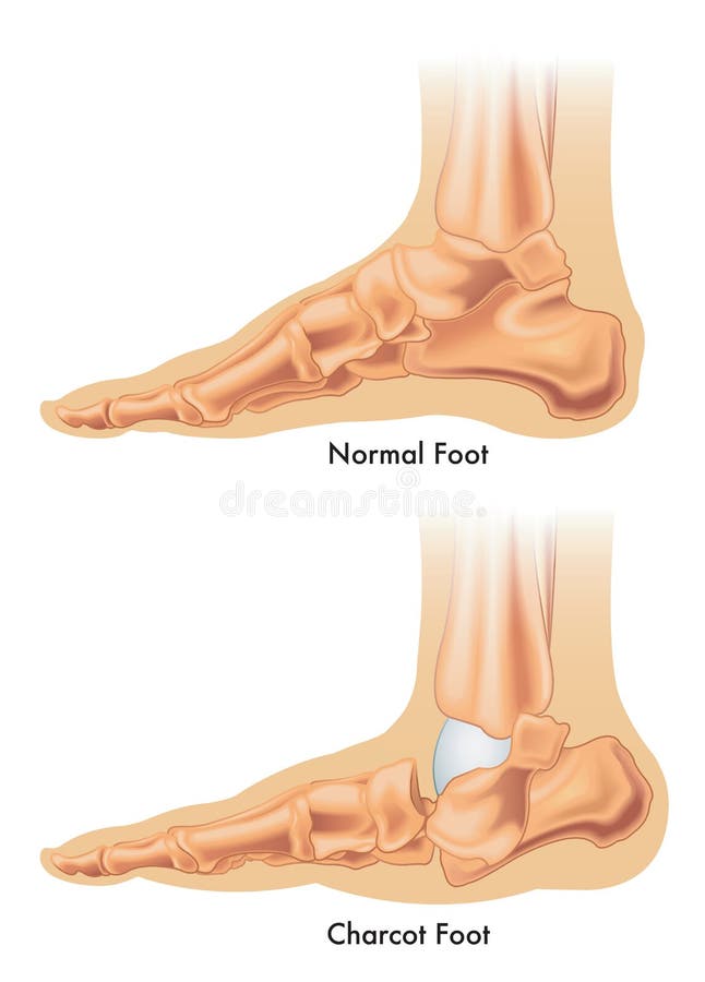 Charcot foot vector illustration
