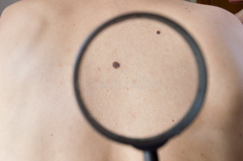 Checking melanoma on back of man stock photos Checking melanoma on back of man stock photos