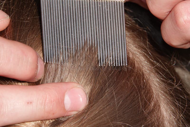 Head lice infection common in young people. Hair being checked using a special head lice comb. Head lice infection common in young people. Hair being checked using a special head lice comb.