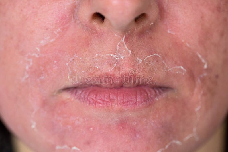 Chemical peeling stock photo. Image of acne, view, mask - 29637038