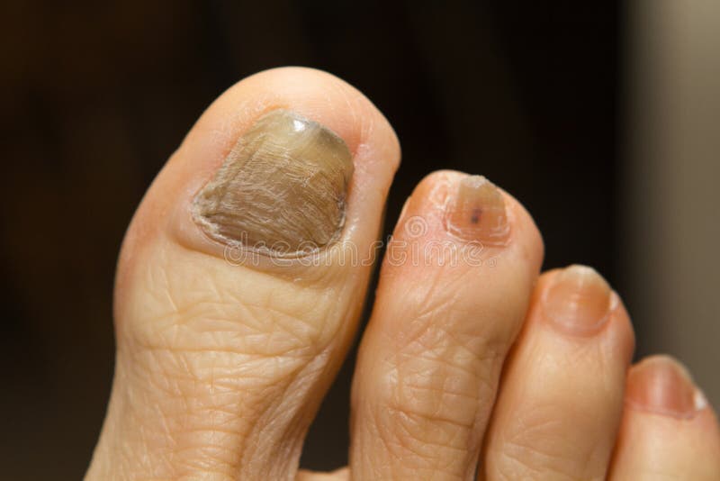 can amoxicillin cure toenail fungus