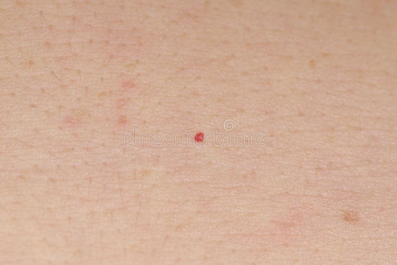 Cherry Angioma O Campbell De Spots Fotografia Stock Immagine