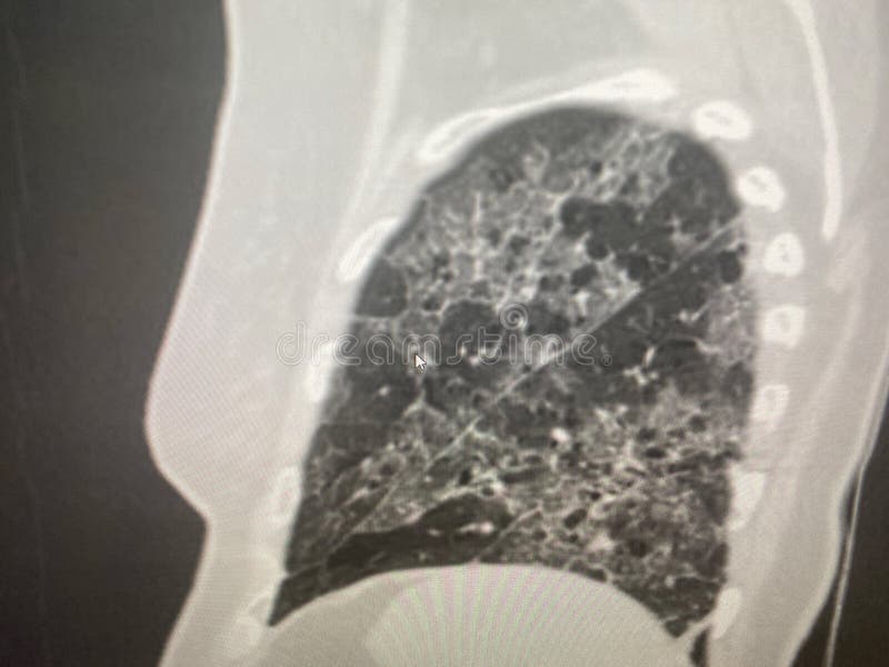 Chest CT Scan of novel Coronavirus COVID-19