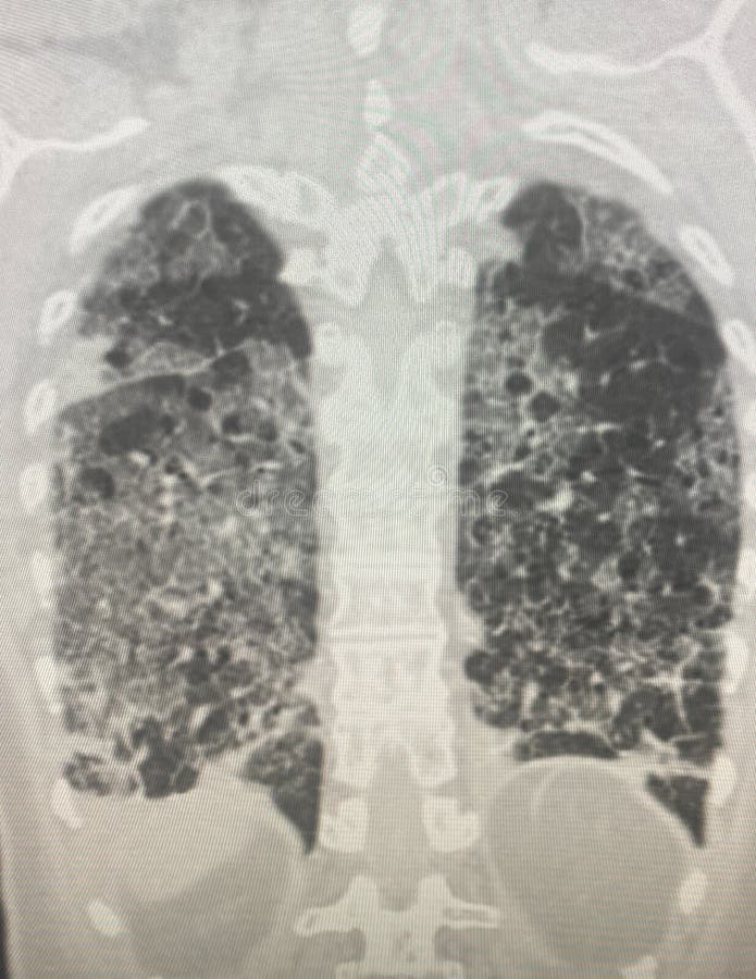 Chest CT Scan of novel Coronavirus COVID-19