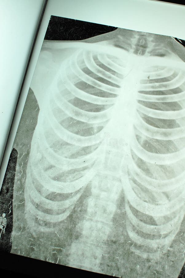Chest Xray Fracture Right Posterior 6th Rib And Possible Fracture