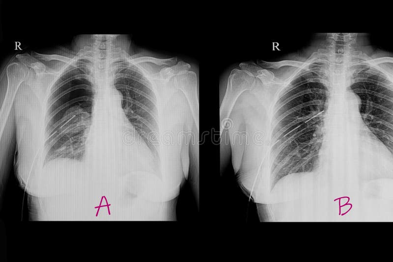 Chest x ray film of a patient with pneumothorax