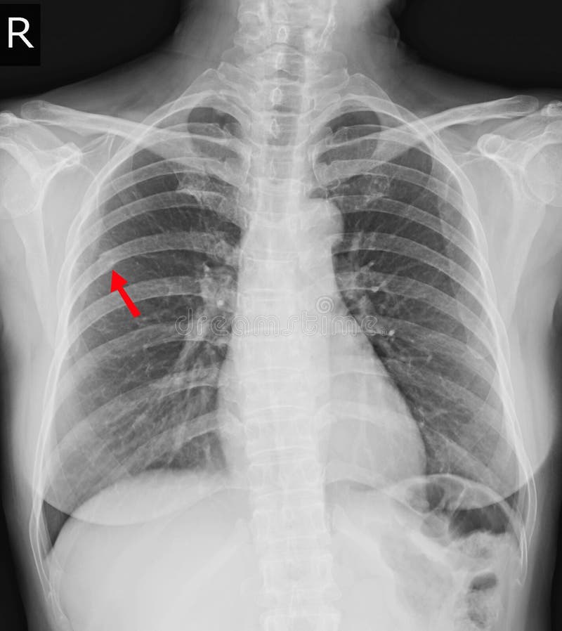 Posterior Ribs X Ray