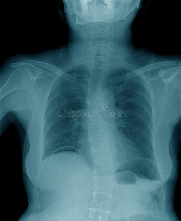 Chest x-ray , hight quality chest x-ray image royalty free stock photo