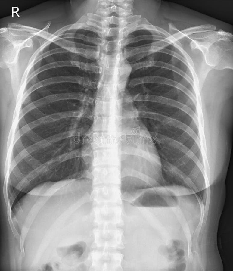 Normal Chest X Ray Side View normal-chest-x-ray-side-view